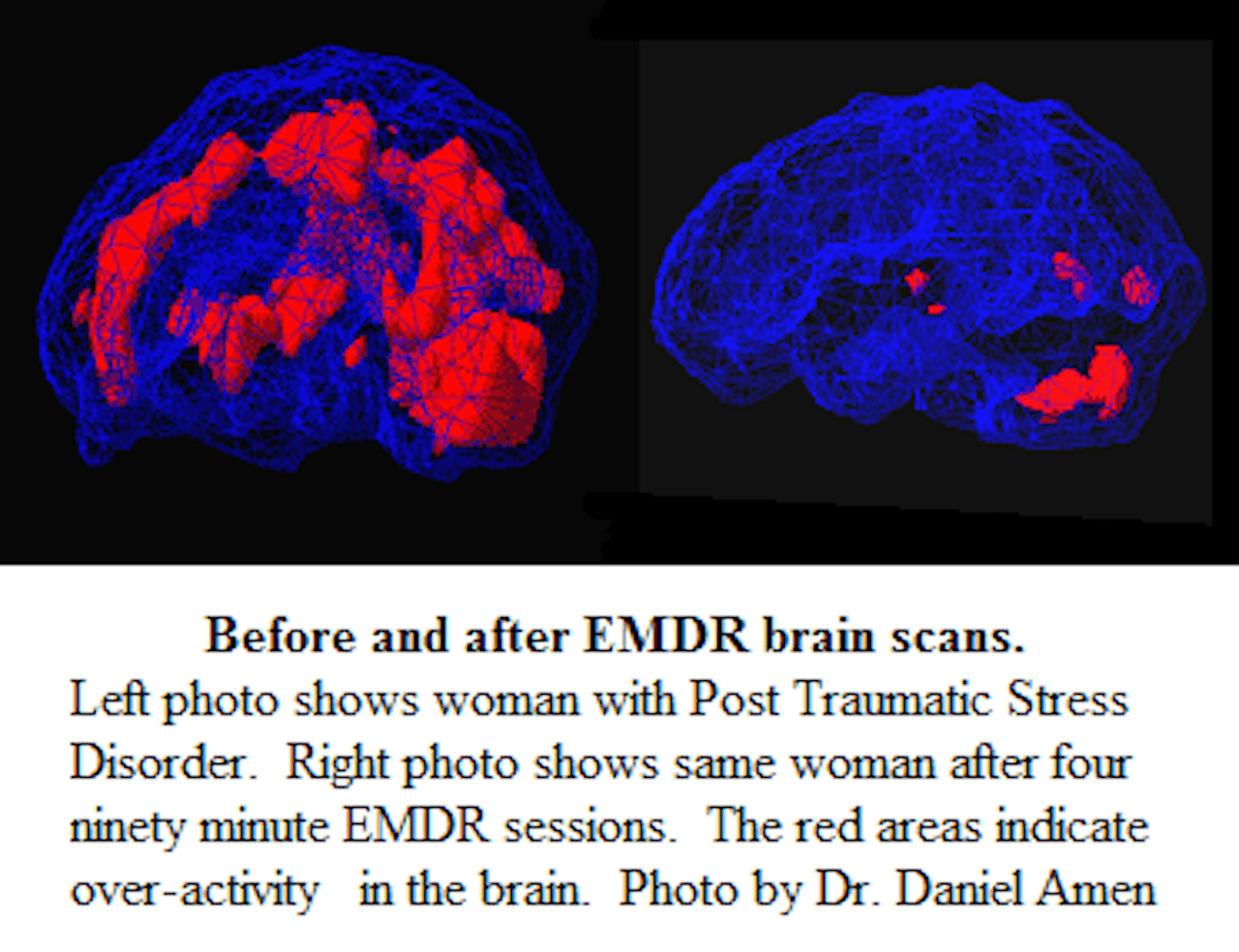 IMAGE - Brain scan, before and after - 1