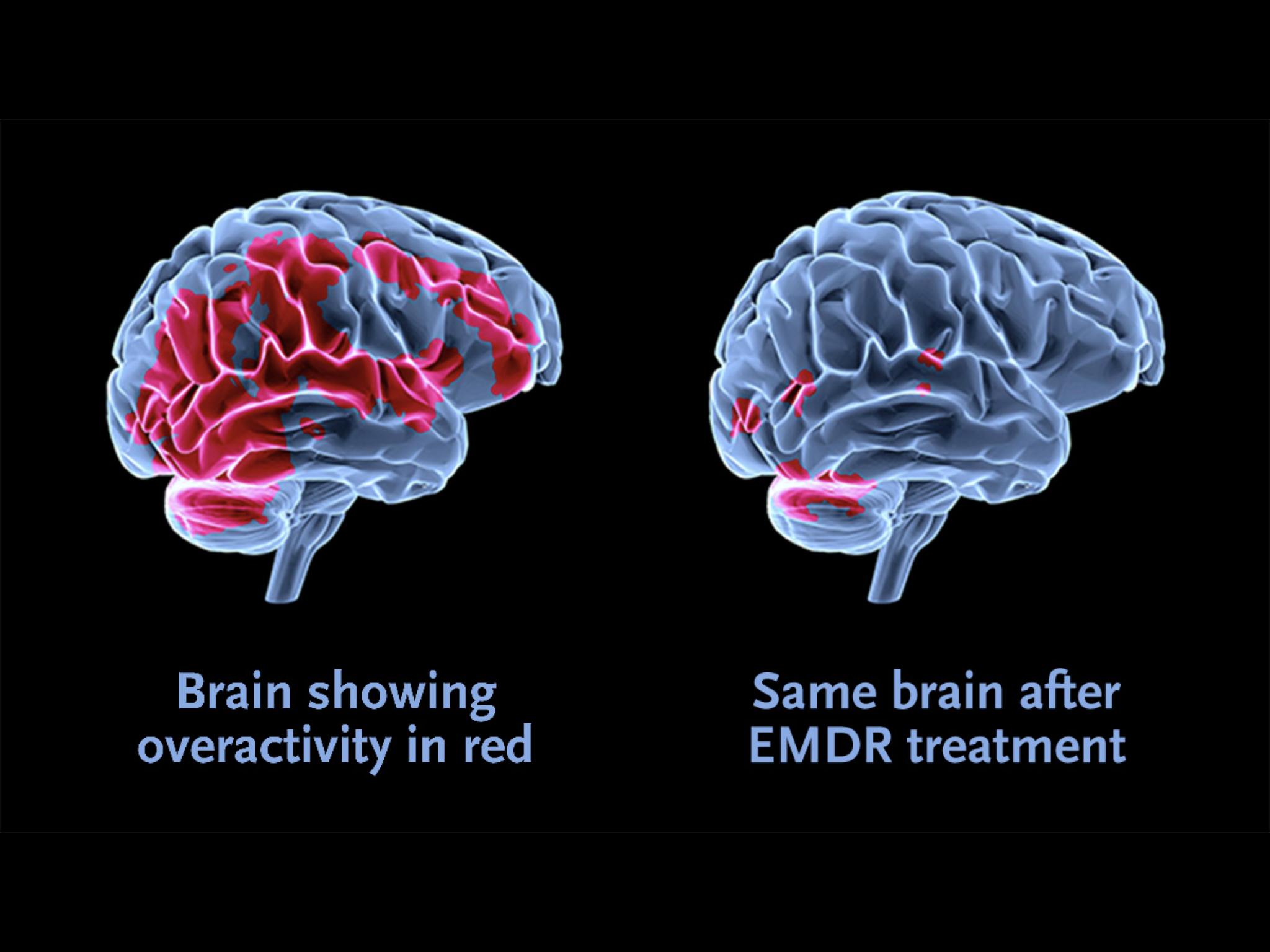 IMAGE - Brain scan, before and after - 2